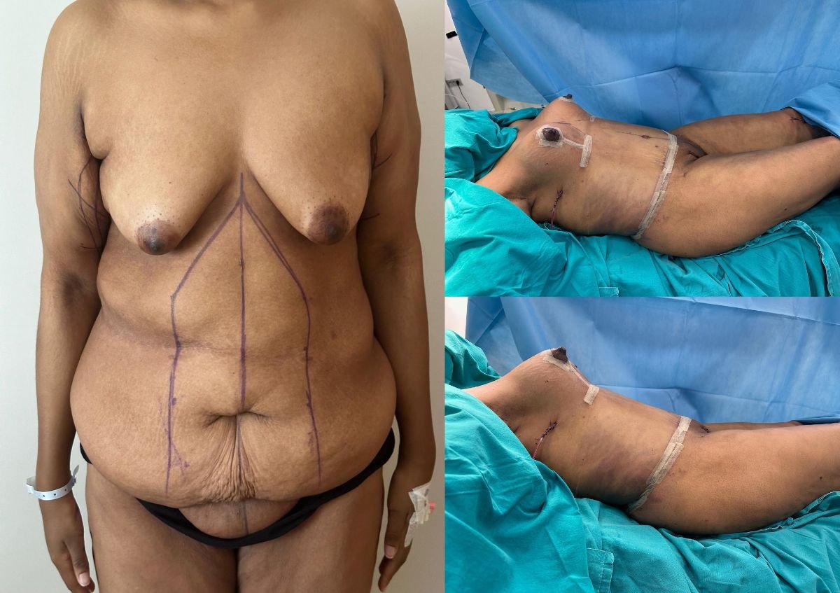 Before and after tummy tuck and breast lift results at Optimed International Hospital