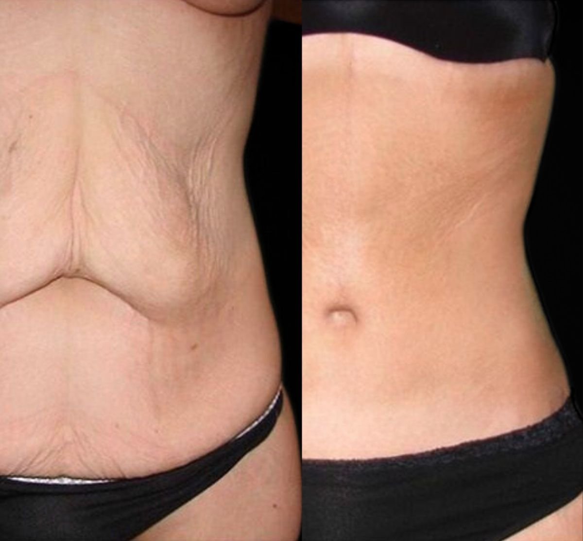 Mommy makeover before and after results at Memorial Şişli Hospital, abdomen contour improved