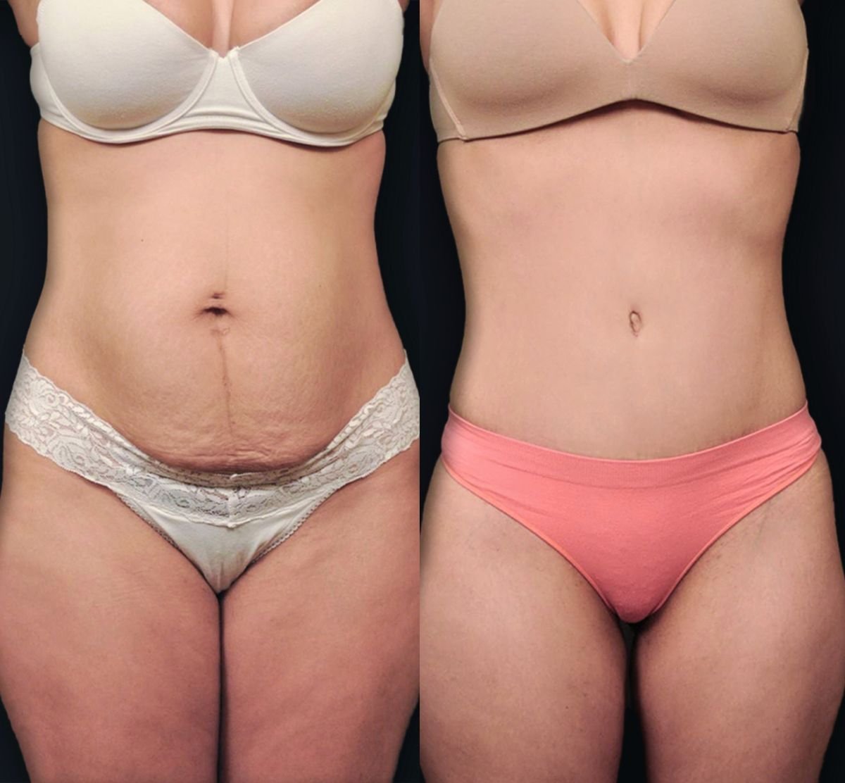 Resultados antes y después de mommy makeover en Memorial Şişli Hospital, abdomen mejorado