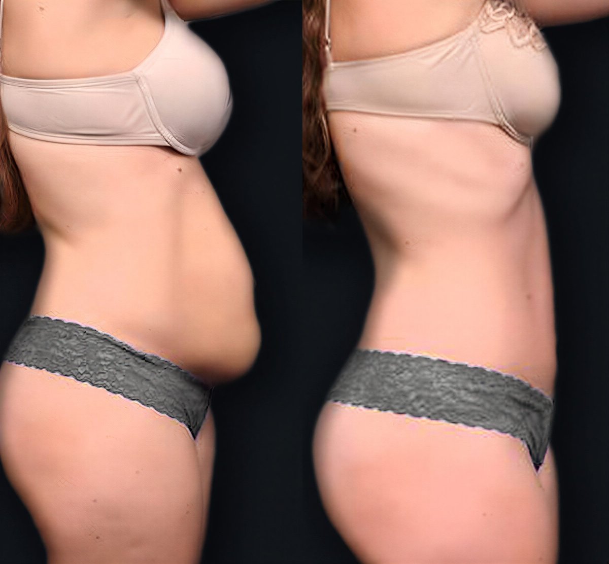 Resultados de mommy makeover antes y después en Memorial Şişli Hospital, contorno abdominal visible