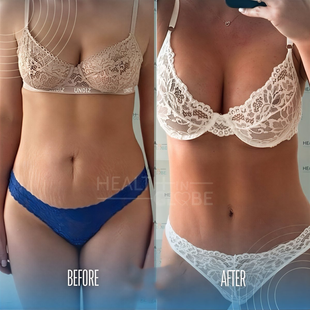 Resultados antes y después de mommy makeover en Memorial Şişli Hospital, mejora corporal
