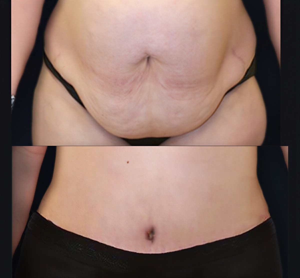 Resultados antes y después de mommy makeover en Memorial Şişli Hospital, abdomen mejorado