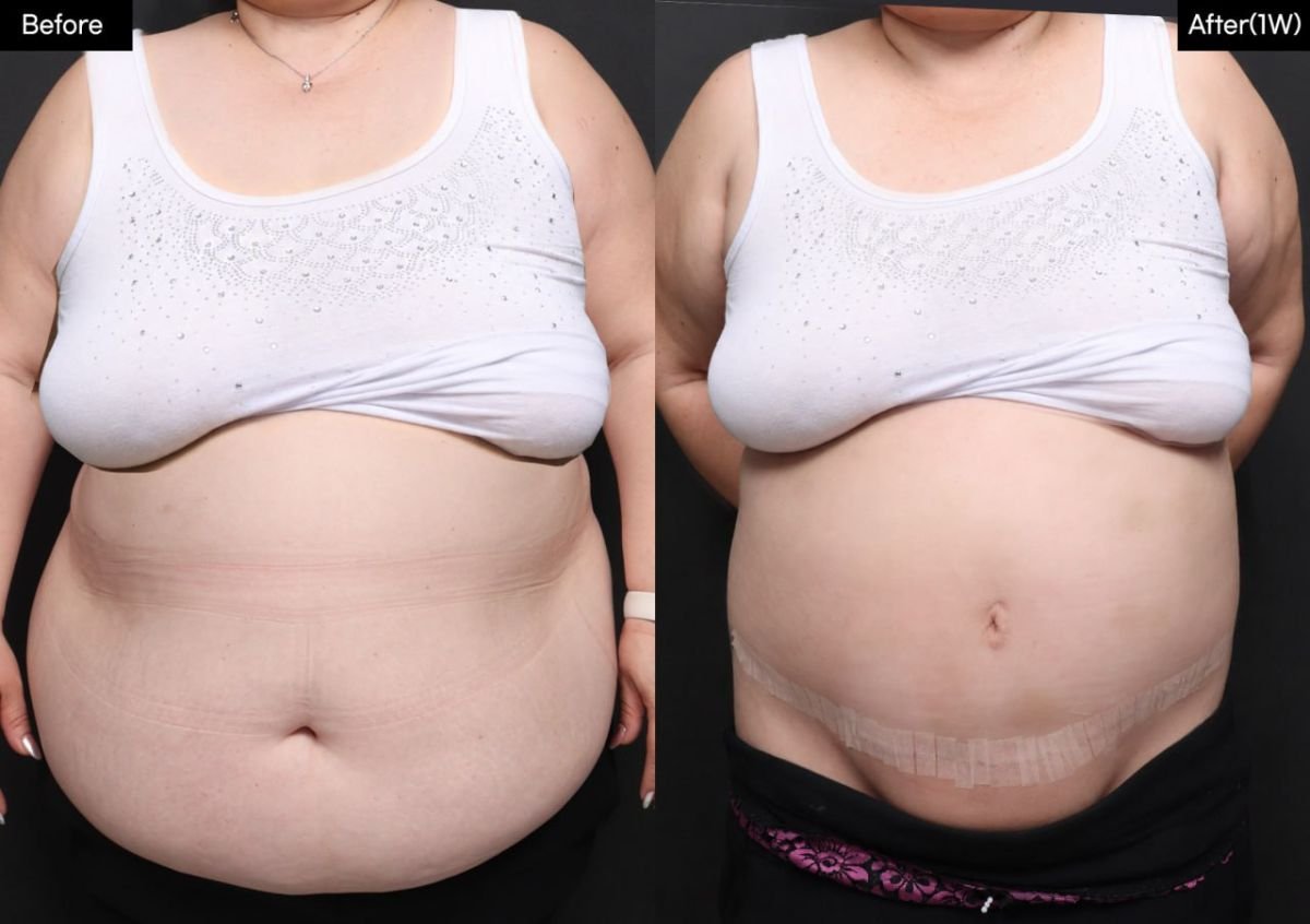 Resultados de liposucción antes y después en VG Plastic Surgery, mejora visible del abdomen