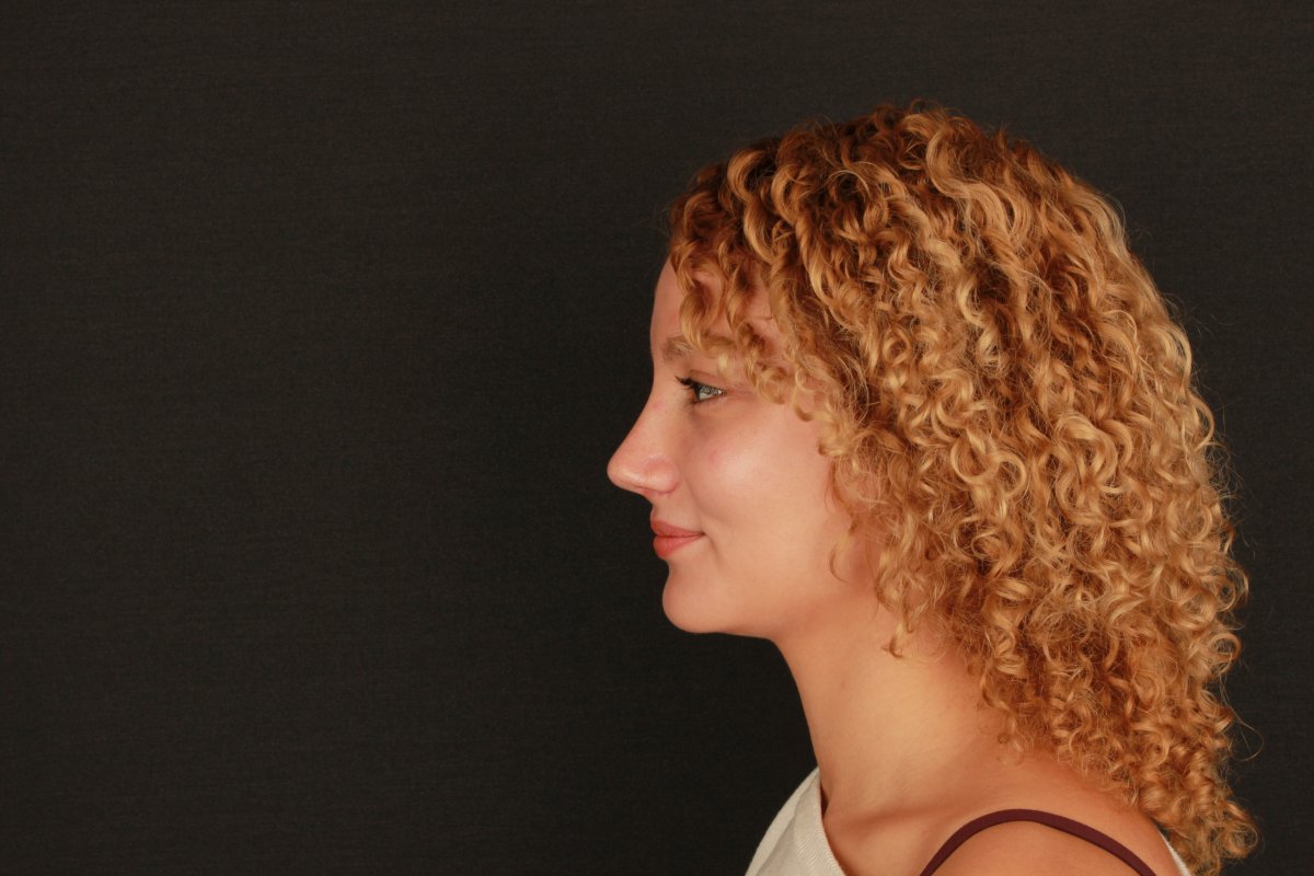 نتيجة عملية تجميل الأنف لمريضة، صورة جانبية تظهر إعادة تشكيل الأنف بشكل طبيعي