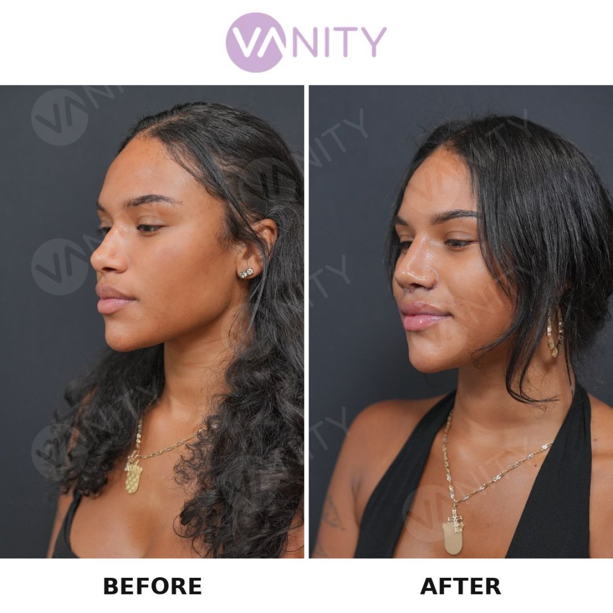 Vorher-nachher-Ergebnisse der Revision-Rhinoplastik bei Vanity Cosmetic Surgery Center, Nasenkorrektur