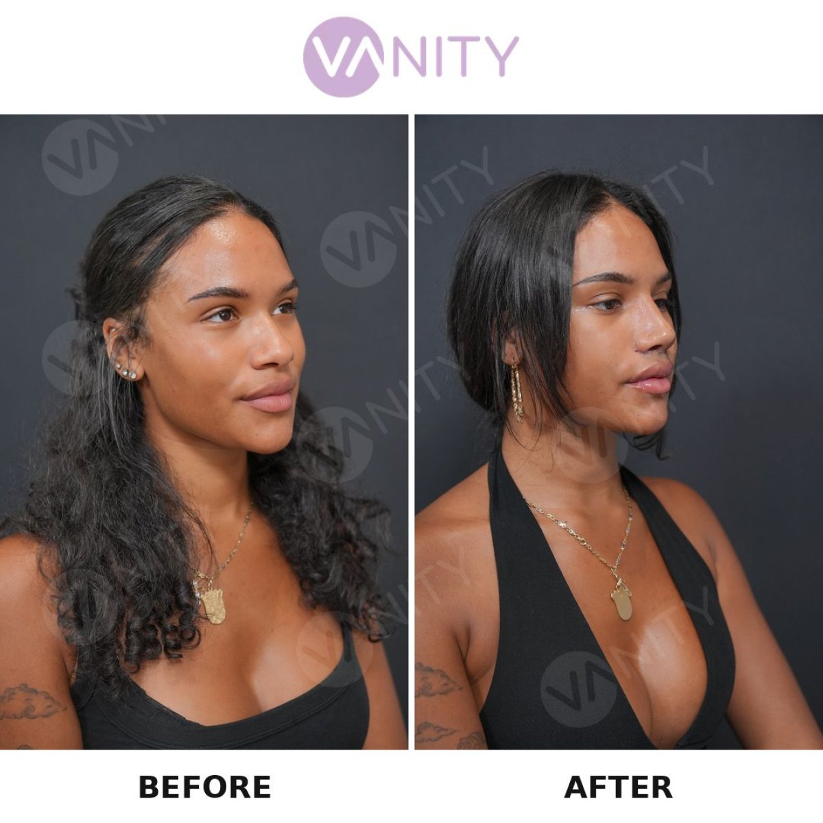 Vorher-nachher-Ergebnisse der Revision-Rhinoplastik bei Vanity Cosmetic Surgery Center, Nasenkorrektur