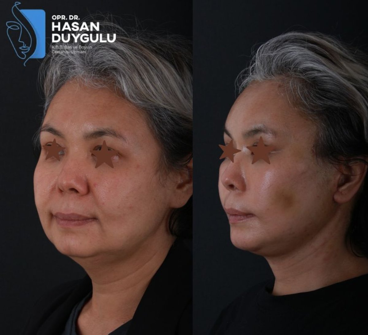 Facelift before and after results at Dr. Hasan Duygulu - Face Aesthetics Clinic Turkey