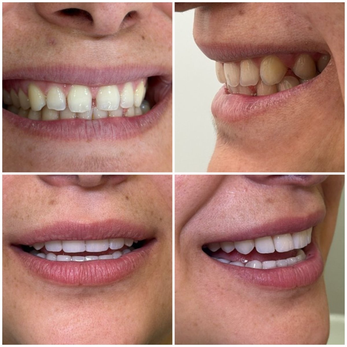 Resultados antes y después de Hollywood Smile: carillas dentales para dientes blancos y parejos
