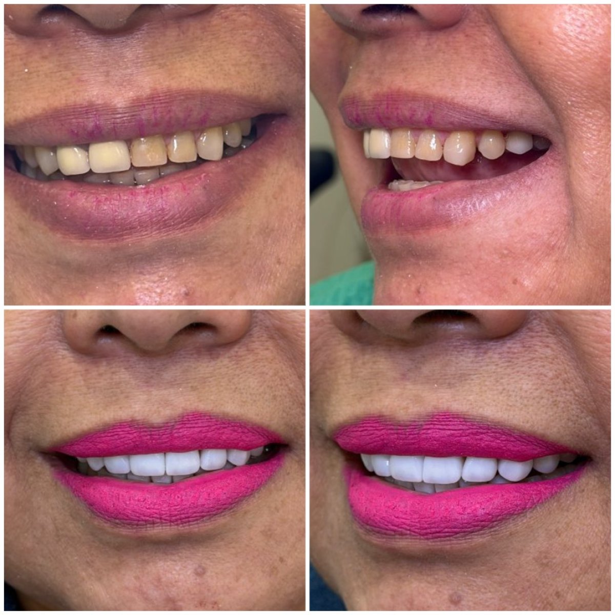 Hollywood Smile before and after results – dental veneers for whiter, even teeth transformation