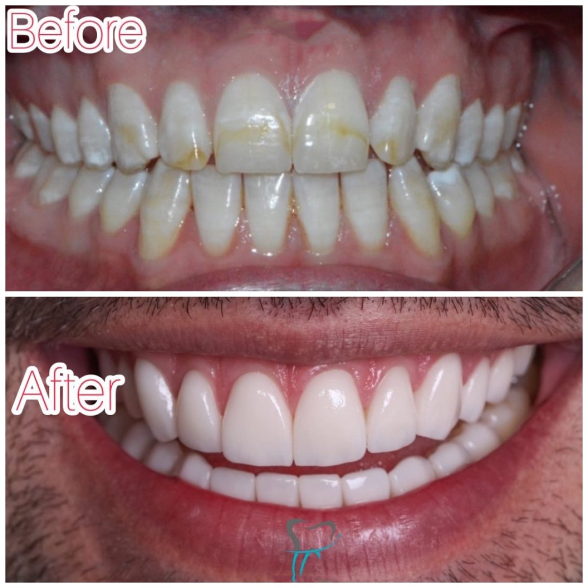 Resultados antes y después de Hollywood Smile – carillas dentales para dientes blancos y parejos