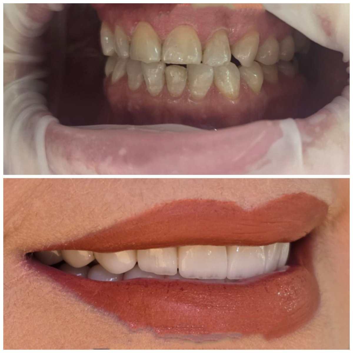 Resultados antes y después de Hollywood Smile: carillas dentales para dientes blancos y parejos