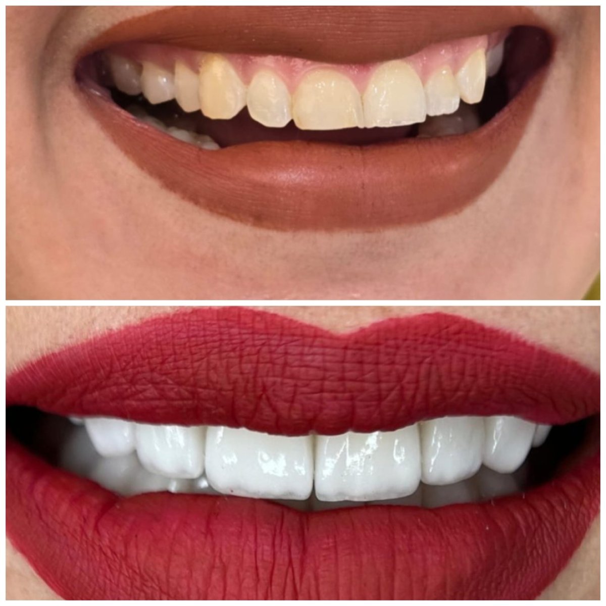 Resultados antes y después de Hollywood Smile – carillas dentales para dientes más blancos y parejos