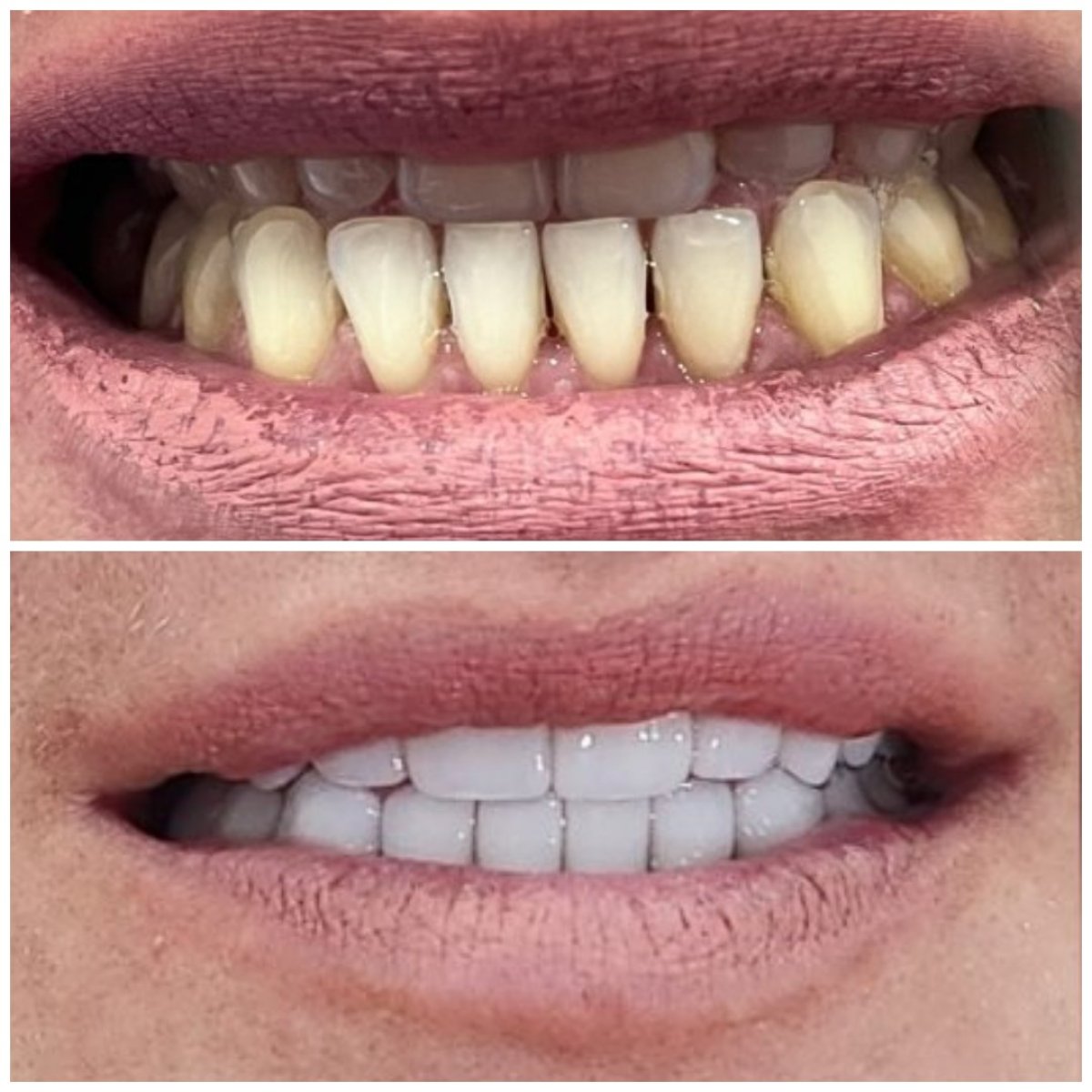 Before and after Hollywood Smile results – dental veneers for whiter, even teeth transformation
