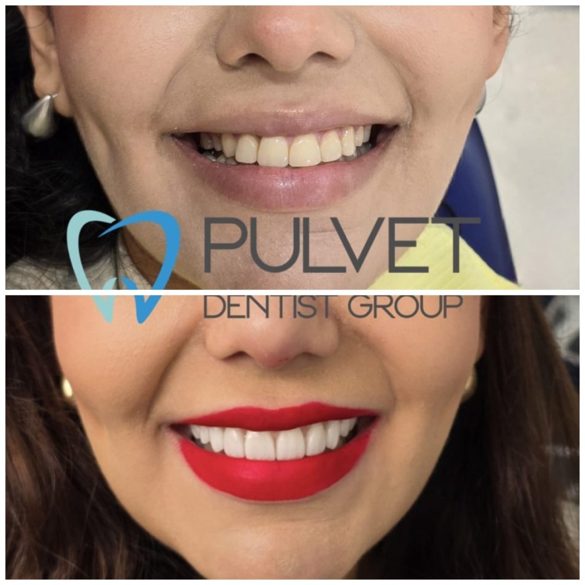 Resultados de antes y después de Hollywood Smile en Pulvet Dentist Group – transformación con carillas