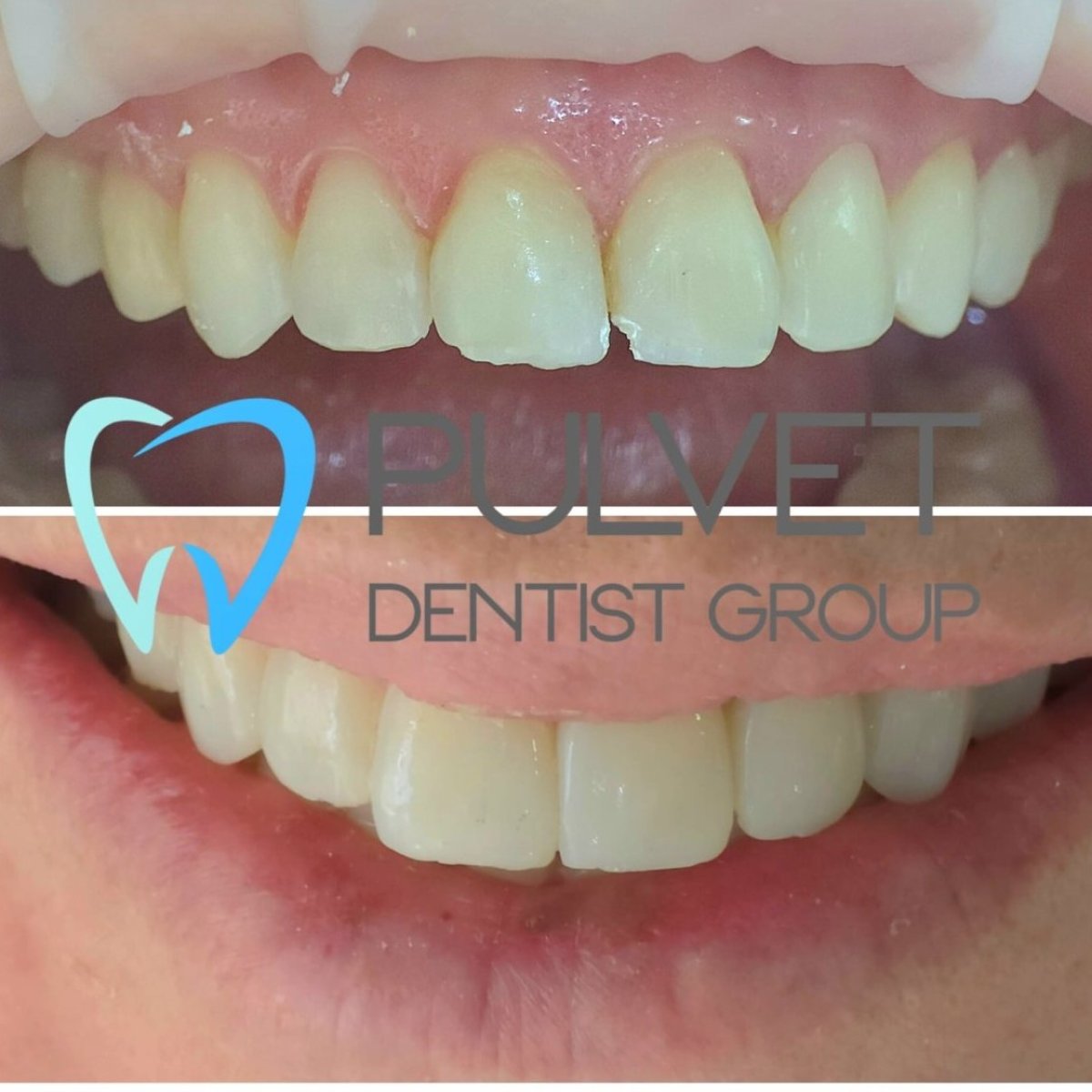 Resultados de antes y después de Hollywood Smile en Pulvet Dentist Group – dientes blancos y parejos