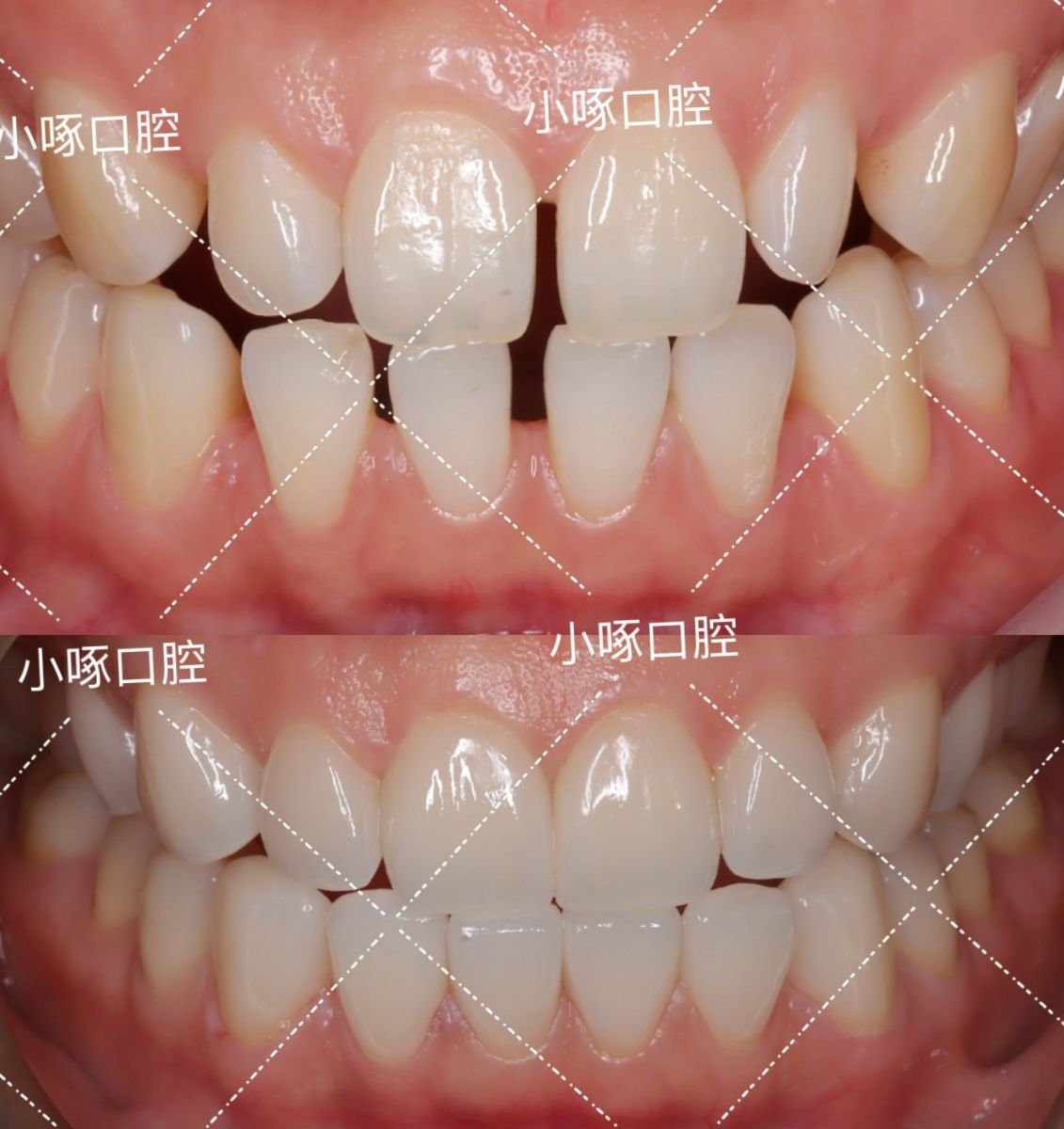 Antes y después de smile makeover en VBright Dental: mejor alineación y estética dental