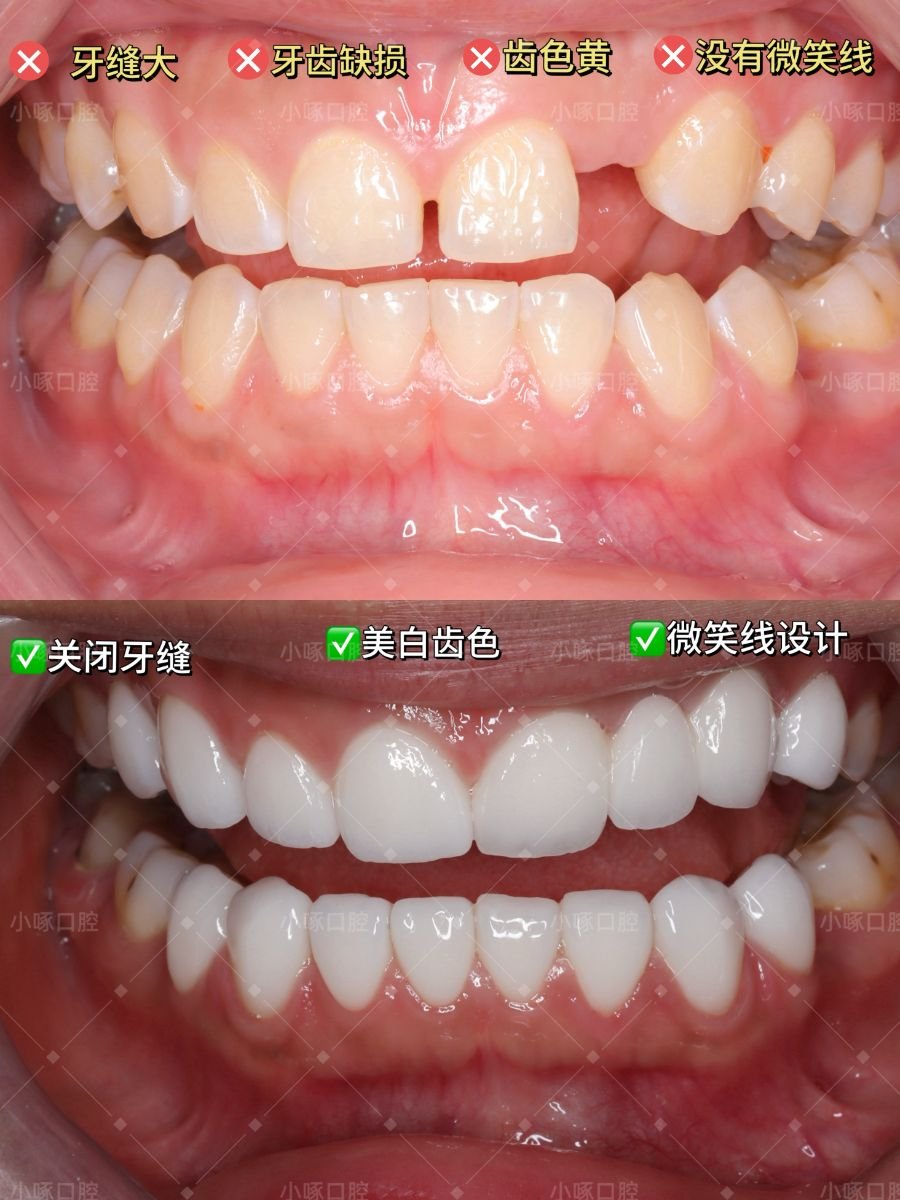 Resultados de antes y después de smile makeover en VBright Dental: dientes blancos y alineados