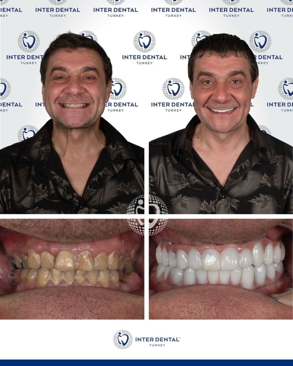 نتائج قبل وبعد تركيب تيجان الأسنان في Inter Dental Turkey – ابتسامة وأسنان أكثر بياضًا
