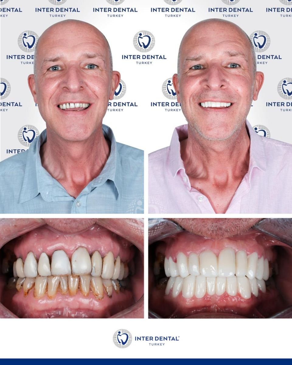 نتائج قبل وبعد تركيب تيجان الأسنان في Inter Dental Turkey، تحول ملحوظ في الابتسامة