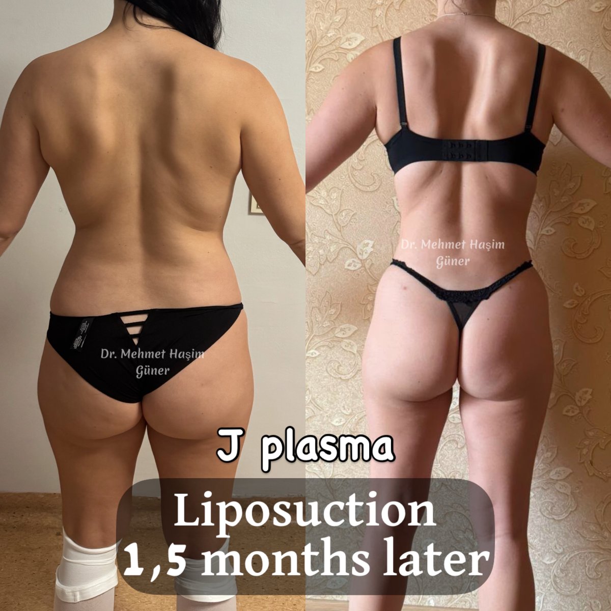 Before and after liposuction with J plasma at Op. Dr. Mehmet Haşim Güner, 1.5 months result