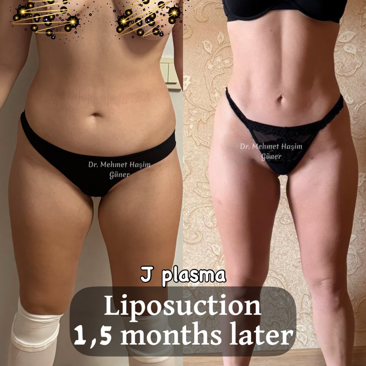 Before and after liposuction with J plasma at Op. Dr. Mehmet Haşim Güner, 1.5 months result