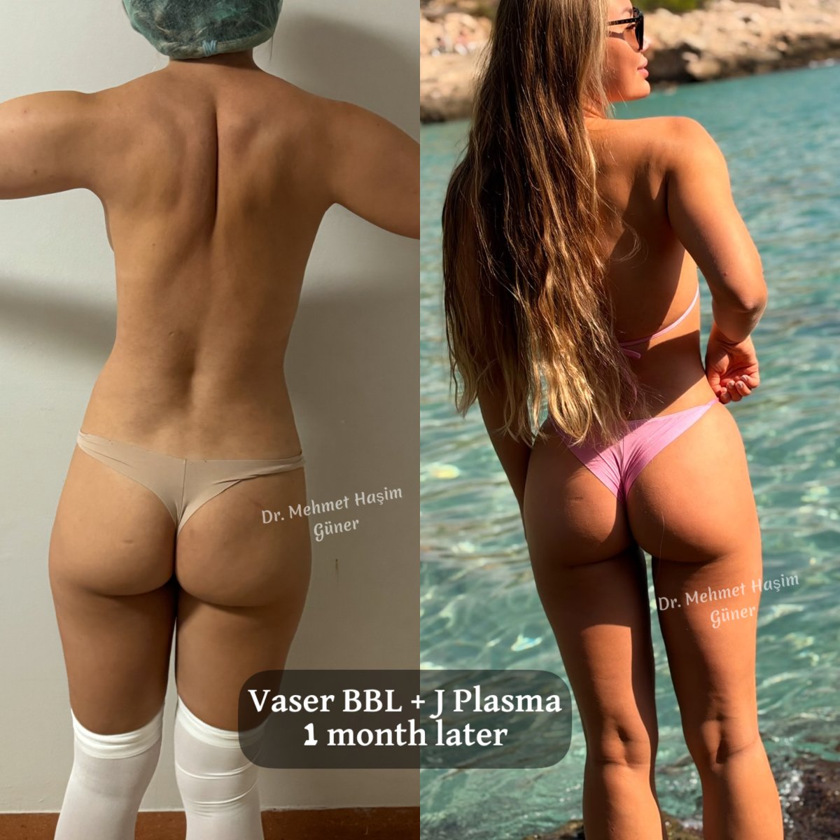 Antes y después de Vaser BBL con J Plasma en Op. Dr. Mehmet Haşim Güner, resultado 1 mes