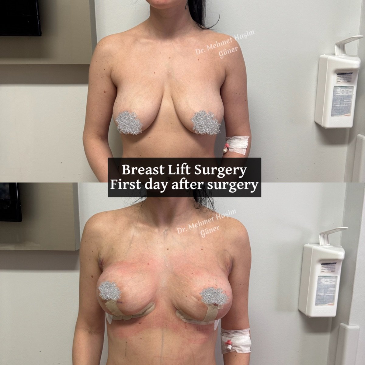 Resultados antes y después de mastopexia en Op. Dr. Mehmet Haşim Güner, elevación visible