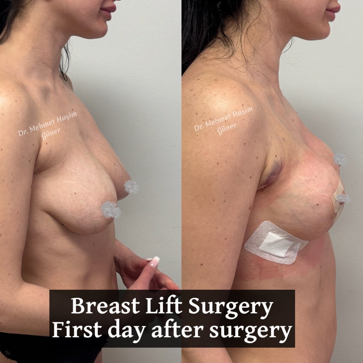 Before and after breast lift results at Op. Dr. Mehmet Haşim Güner, first day post-surgery