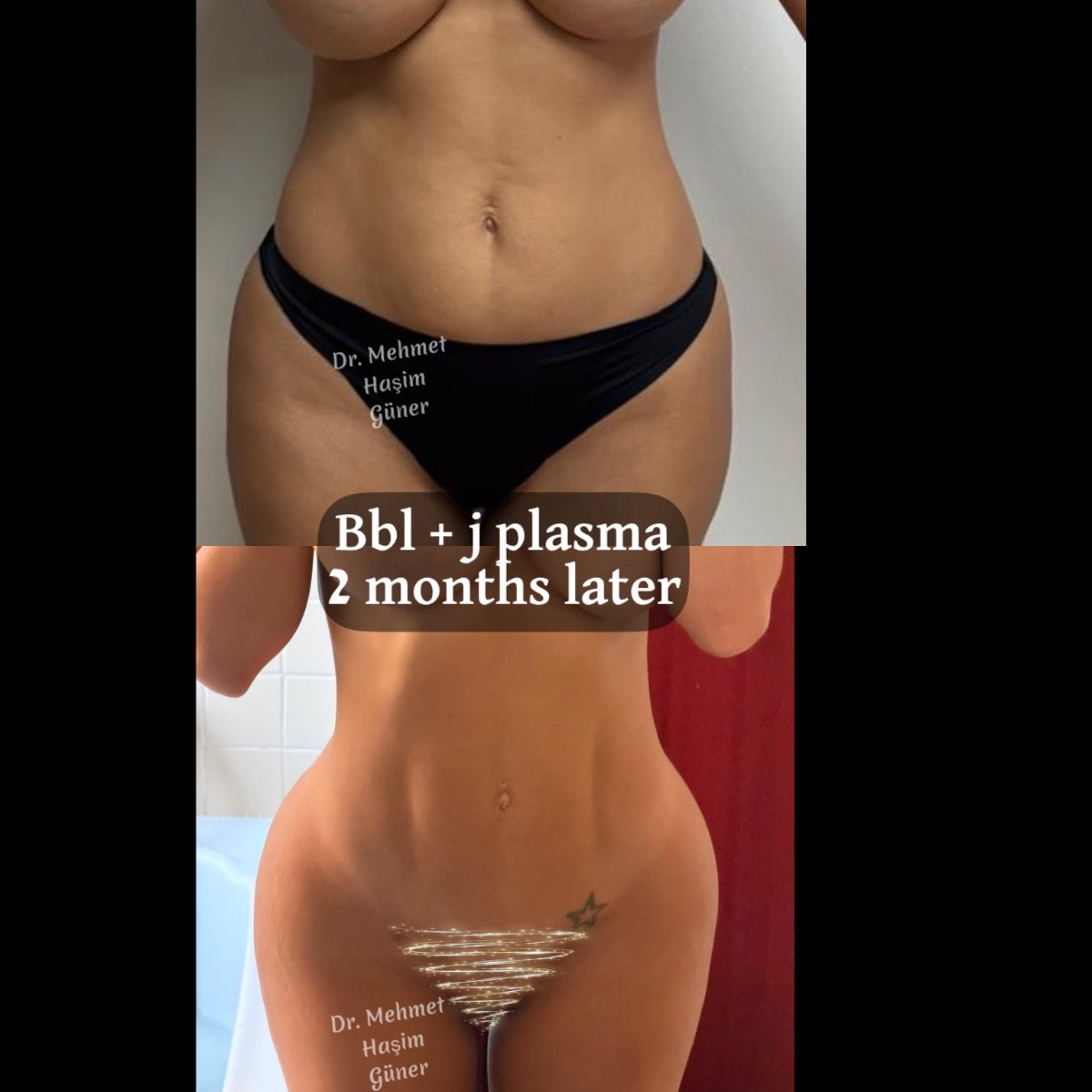 Antes y después de Brazilian Butt Lift con J-Plasma en Op. Dr. Mehmet Haşim Güner, resultado 2 meses