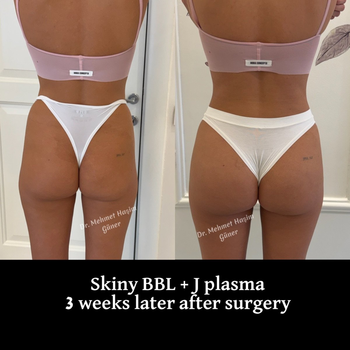 Antes y después de Skinny BBL con J plasma en Op. Dr. Mehmet Haşim Güner, resultado a 3 semanas