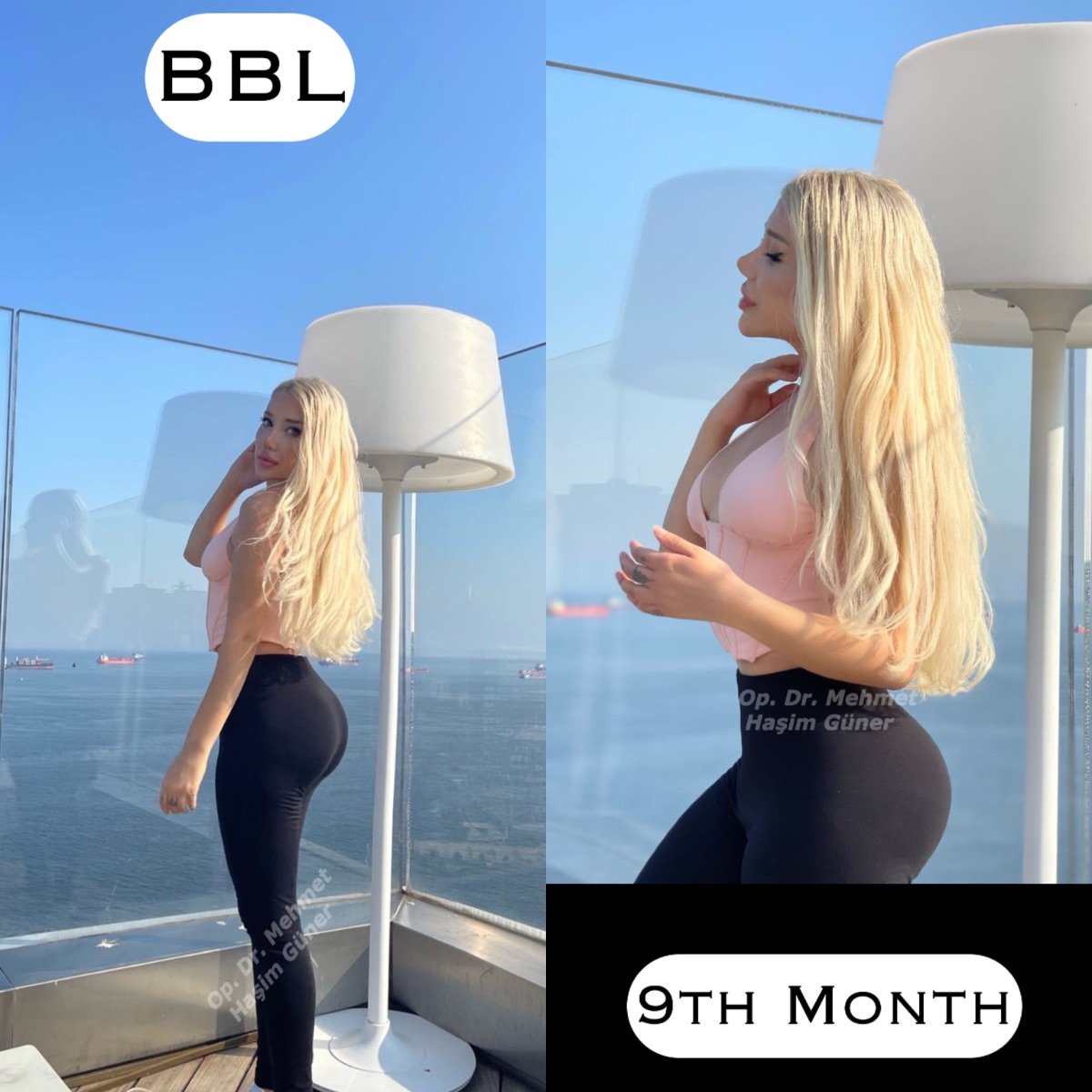 Resultados de Brazilian Butt Lift a los 9 meses en Op. Dr. Mehmet Haşim Güner