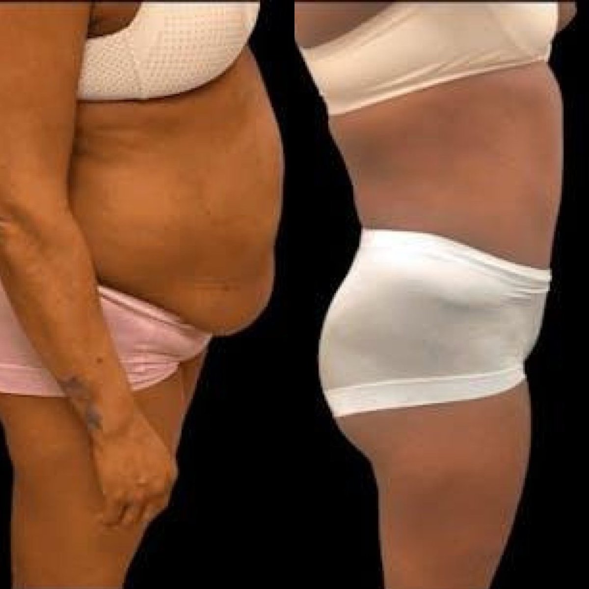 نتائج قبل وبعد عملية تجميل الأم في مستشفى هيسار الدولي، نحت الجسم
