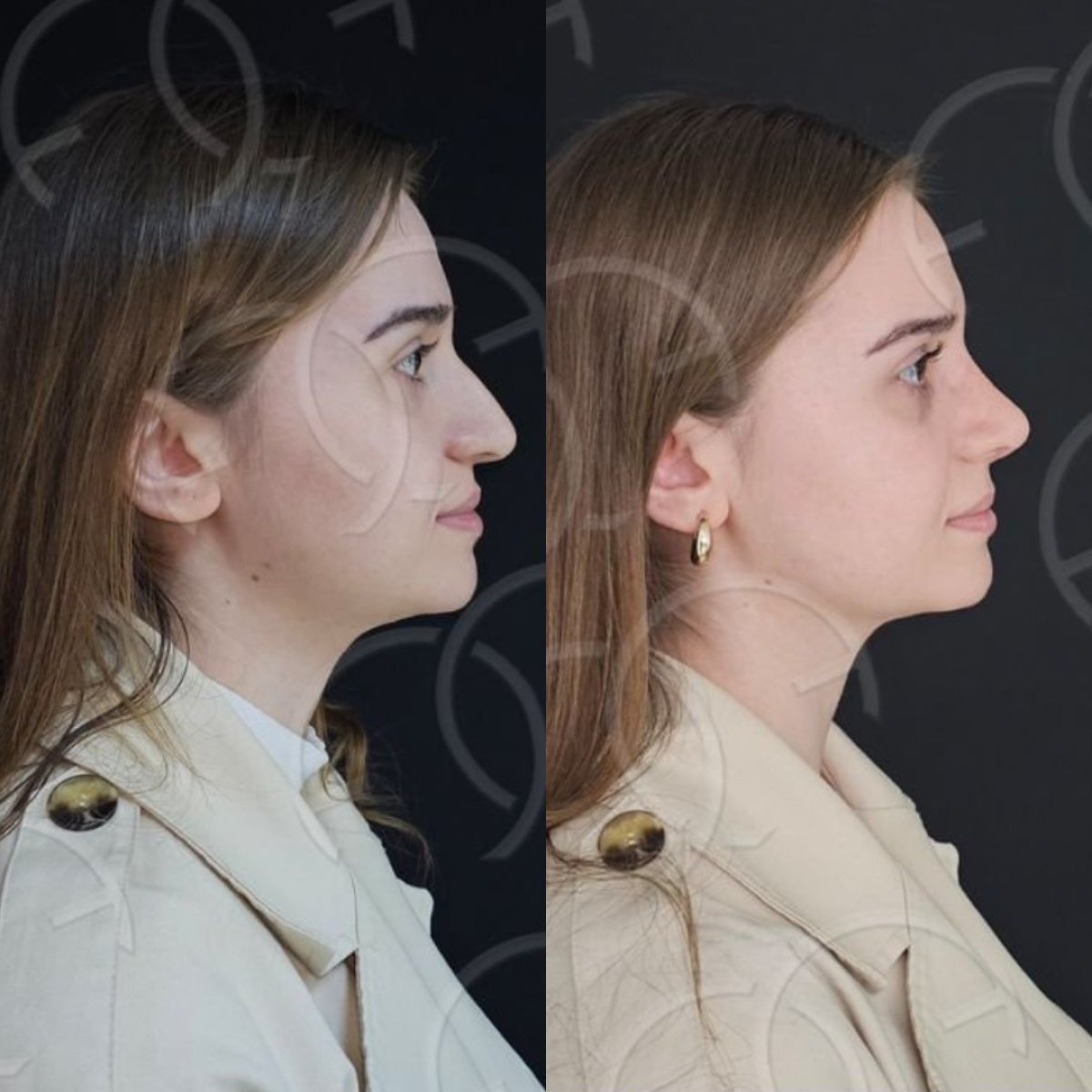 Resultados de rinoplastia antes y después en Dr. Safa Manav Clinic, perfil nasal mejorado
