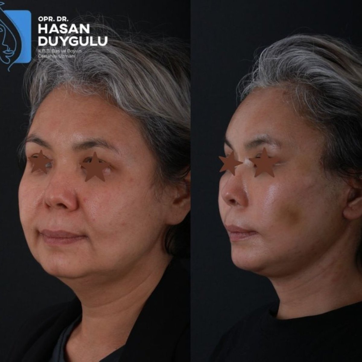 Facelift before and after results at Dr. Hasan Duygulu - Face Aesthetics Clinic Turkey