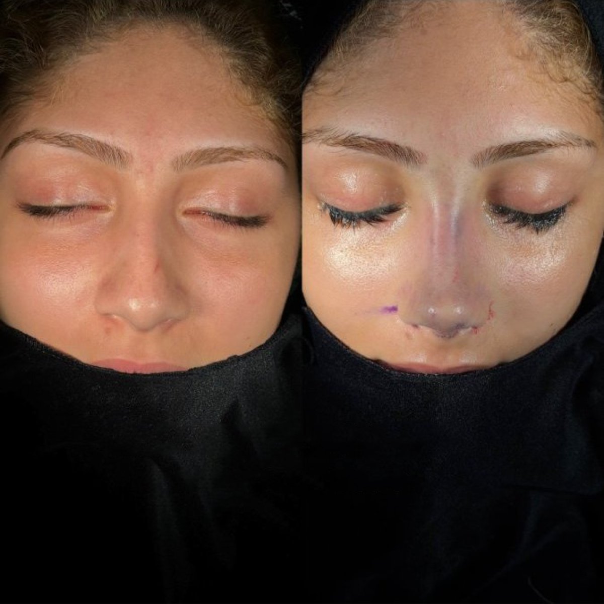 نتائج عملية تجميل الأنف قبل وبعد، إعادة تشكيل الأنف لتحسين تناسق الوجه