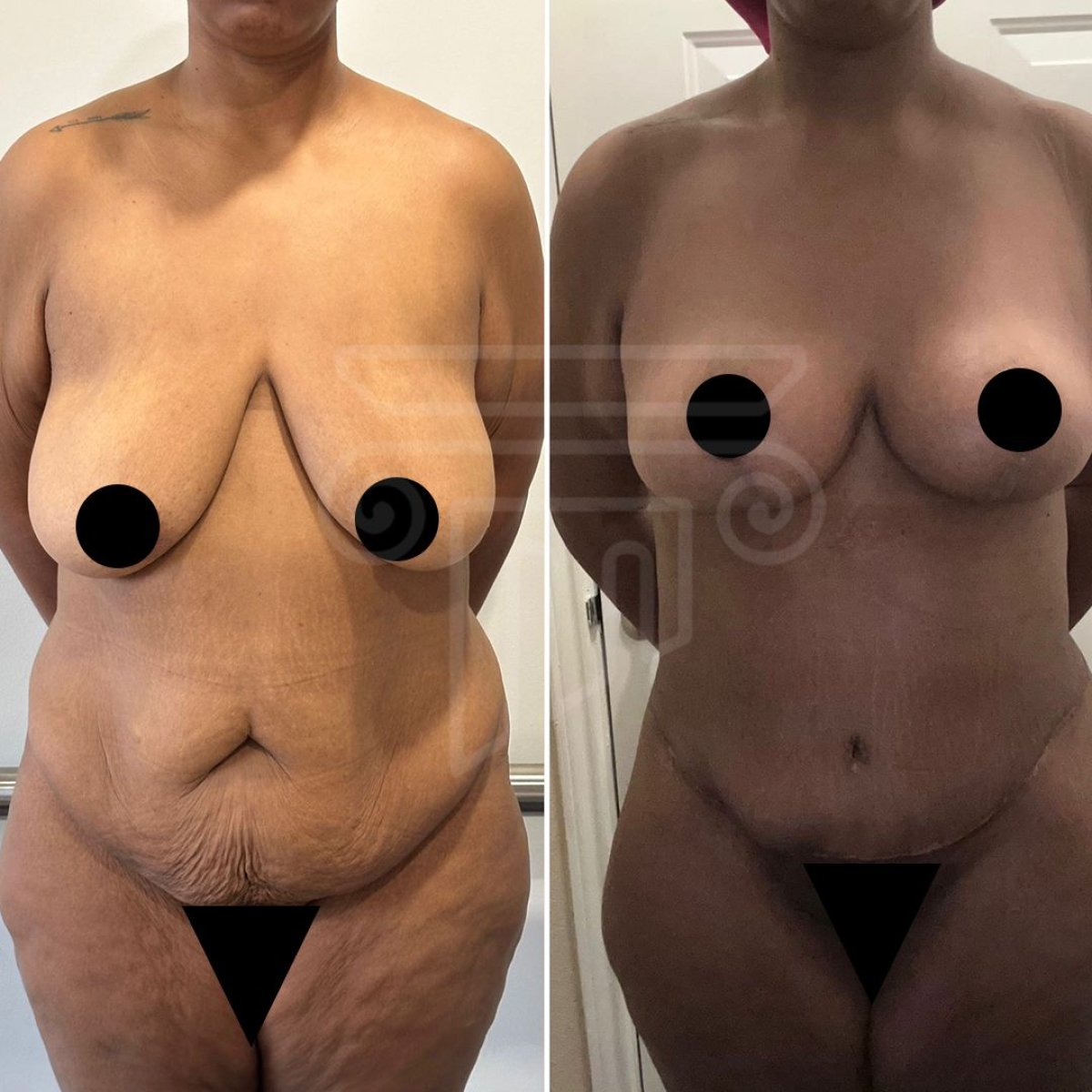 نتائج قبل وبعد عملية تجميل الأم في عيادة د. صفا مناف – تحسين شكل الجسم