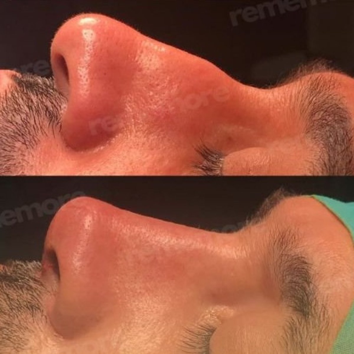 نتائج تجميل الأنف قبل وبعد في مستشفى ميموريال بهجيليفلر، تحسين شكل الأنف