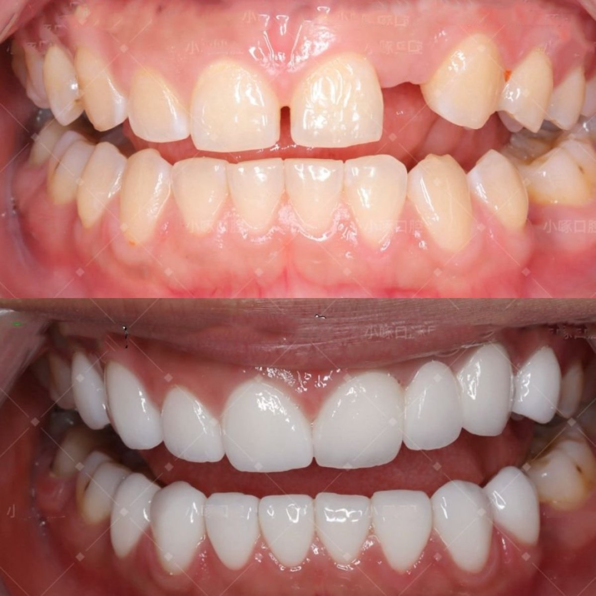 Antes y después de smile makeover en VBright Dental – resultado de carillas dentales
