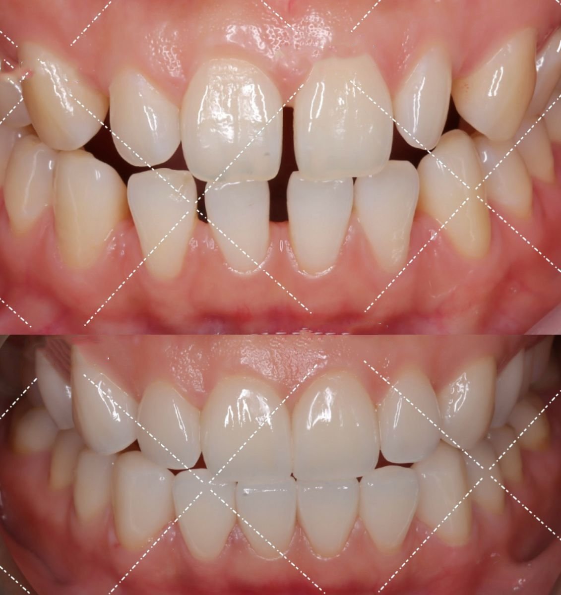 Vorher-nachher Smile Makeover bei VBright Dental – bessere Ausrichtung und weiße Zähne