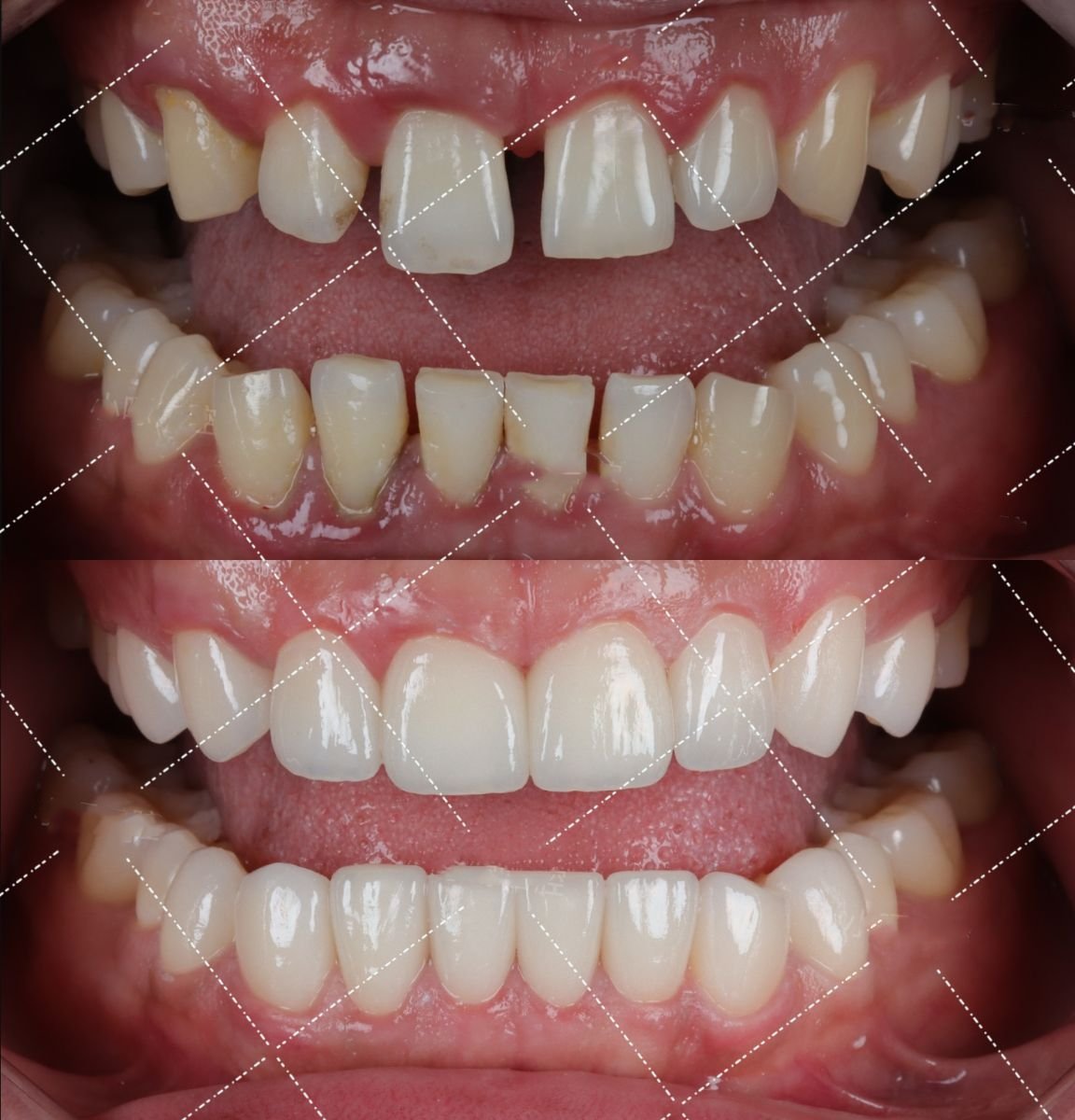 Antes y después de smile makeover en VBright Dental: carillas para alinear los dientes