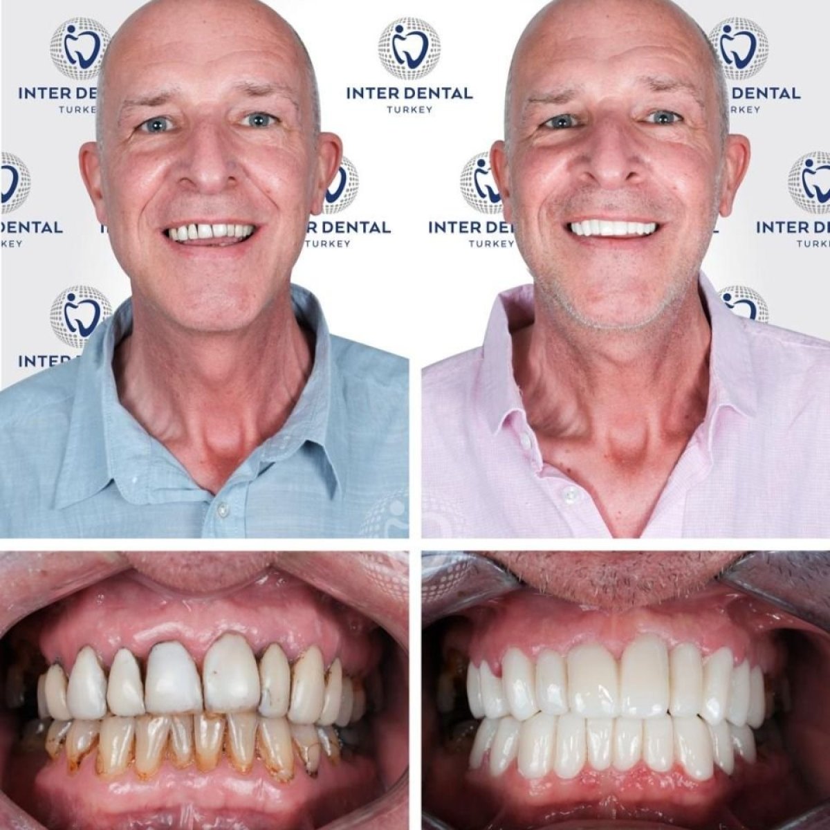 Before and after dental crown installation results at Inter Dental Turkey – improved smile aesthetics