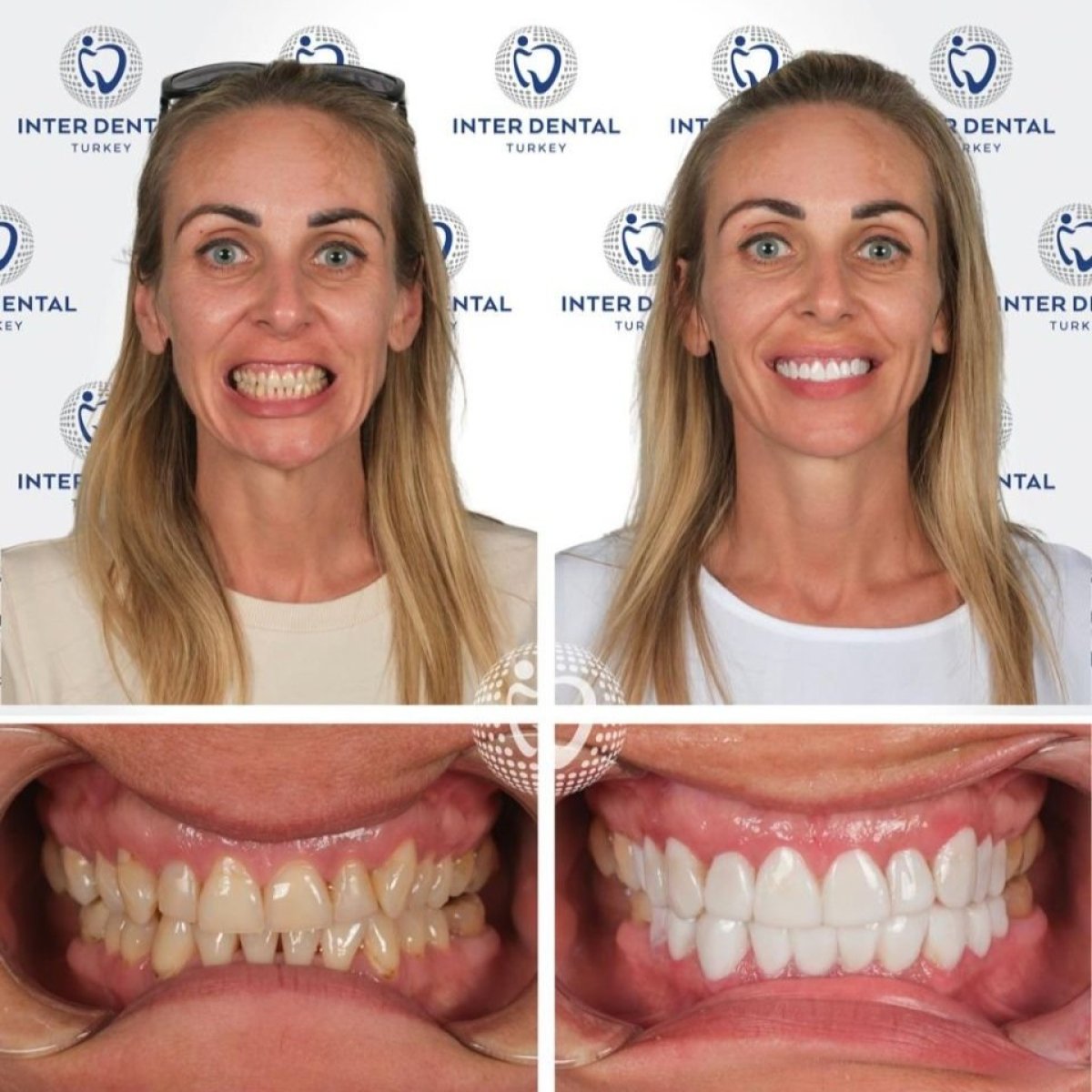 Resultados antes y después de coronas dentales en Inter Dental Turkey – transformación de sonrisa