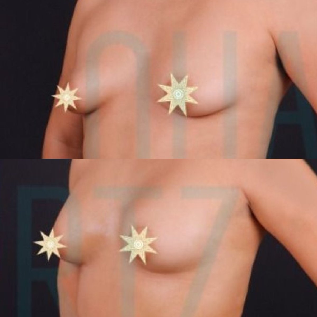 Antes y después de aumento de senos con transferencia de grasa en Quartz Hospital, resultado natural
