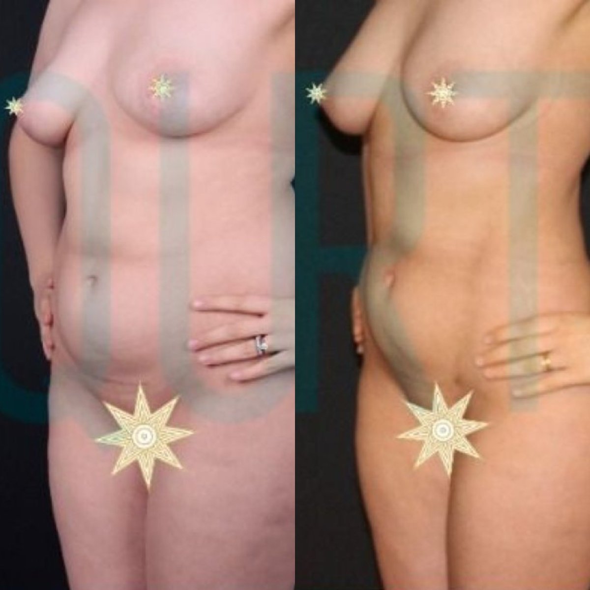 Antes y después de aumento de senos con transferencia de grasa en Quartz Hospital, resultado corporal