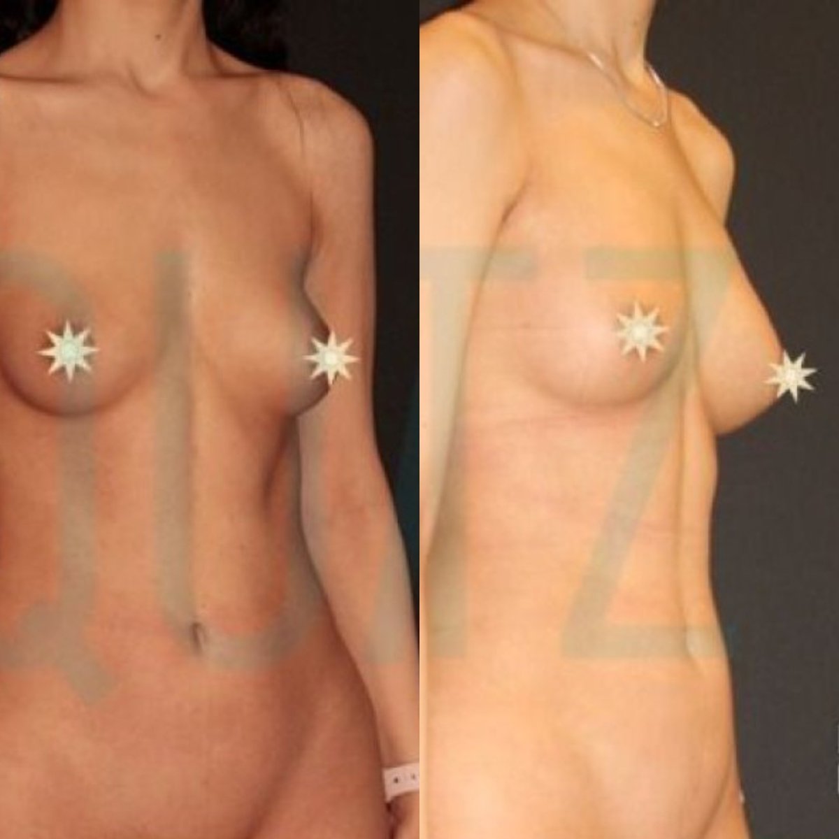 Resultados antes y después de aumento de senos con lipofilling en Quartz Hospital