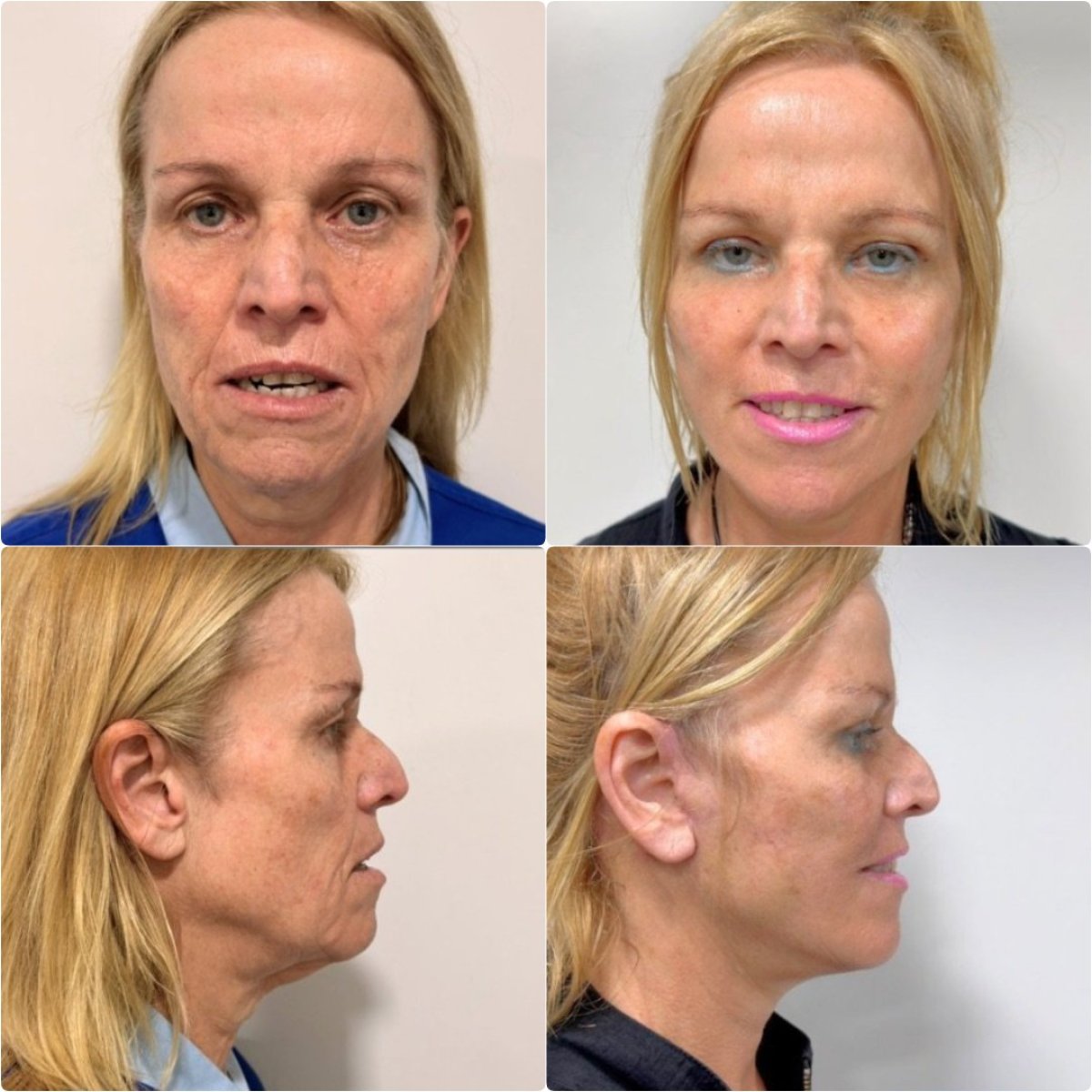 Resultados de lifting facial antes y después en ID Clinic Bangkok, rejuvenecimiento visible