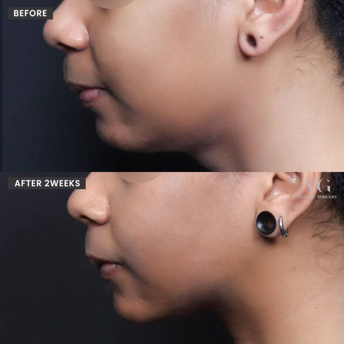 نتائج شفط دهون الذقن قبل وبعد في VG Plastic Surgery – تحسين تحديد الفك