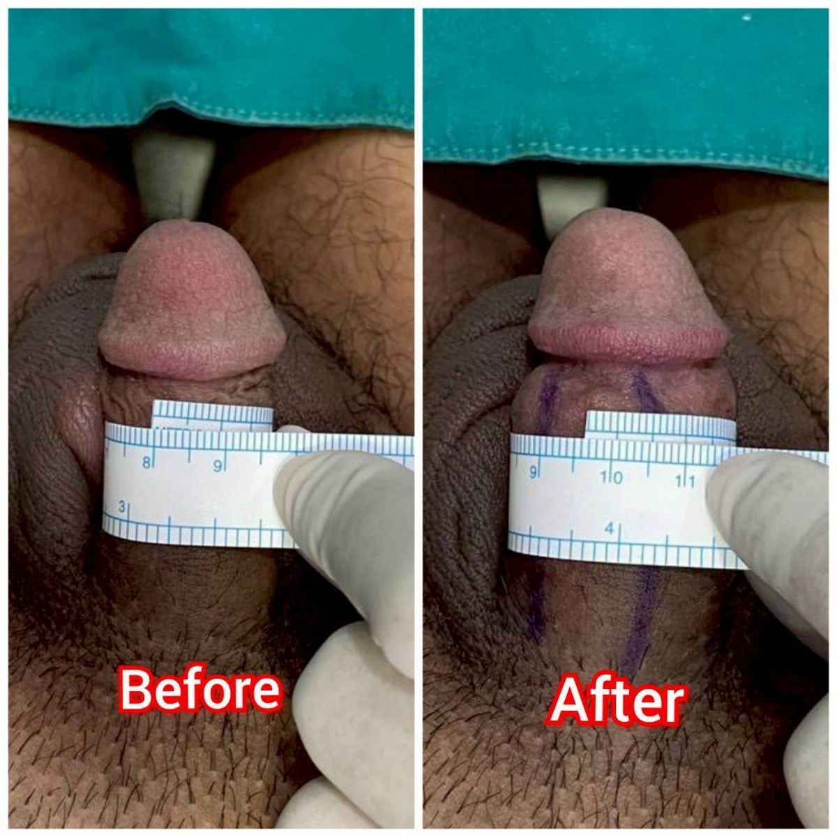 Resultados antes y después de aumento de pene en Eternity Clinic Phuket By Dr.Beer, mayor grosor