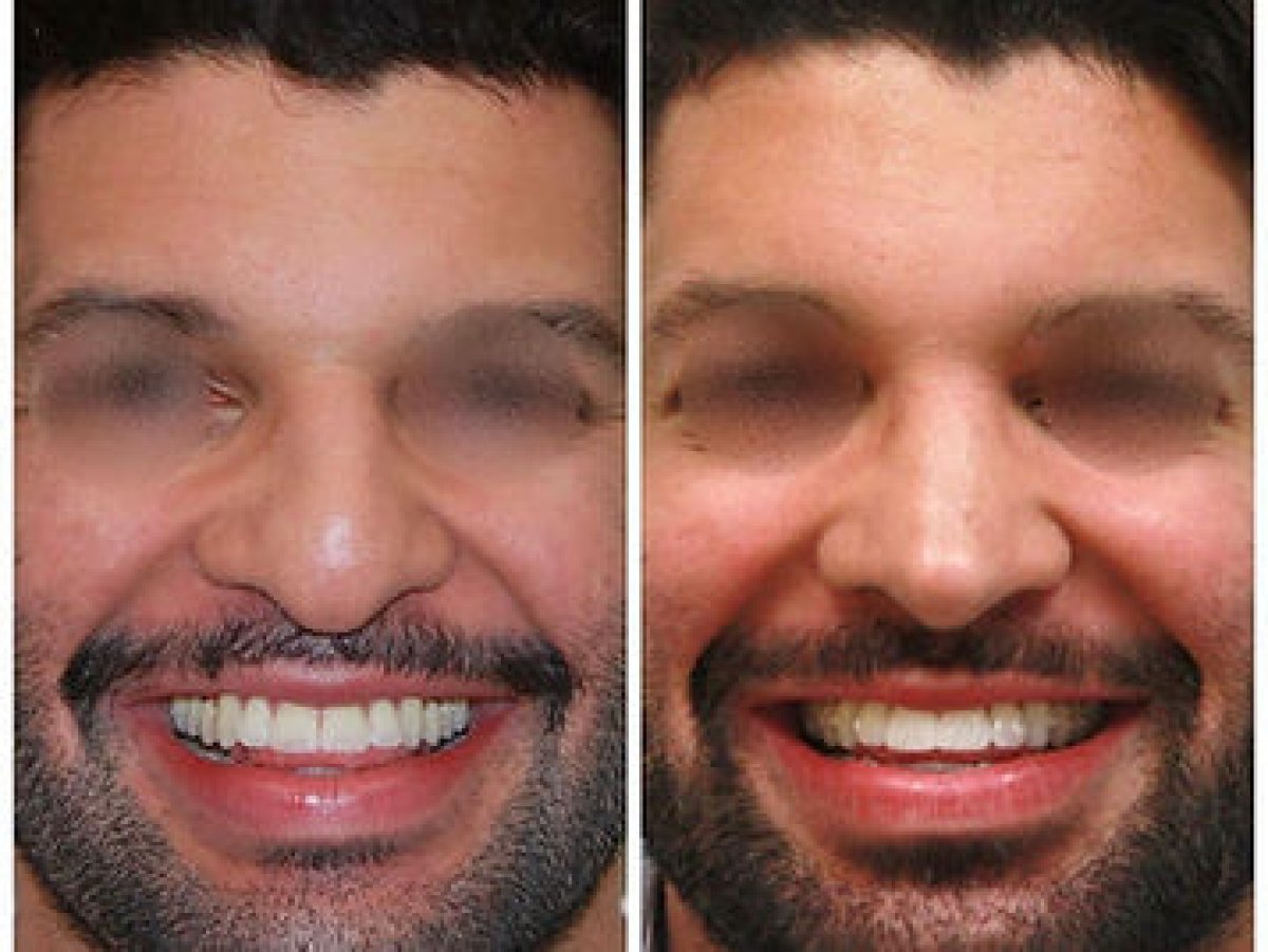 before and after photo