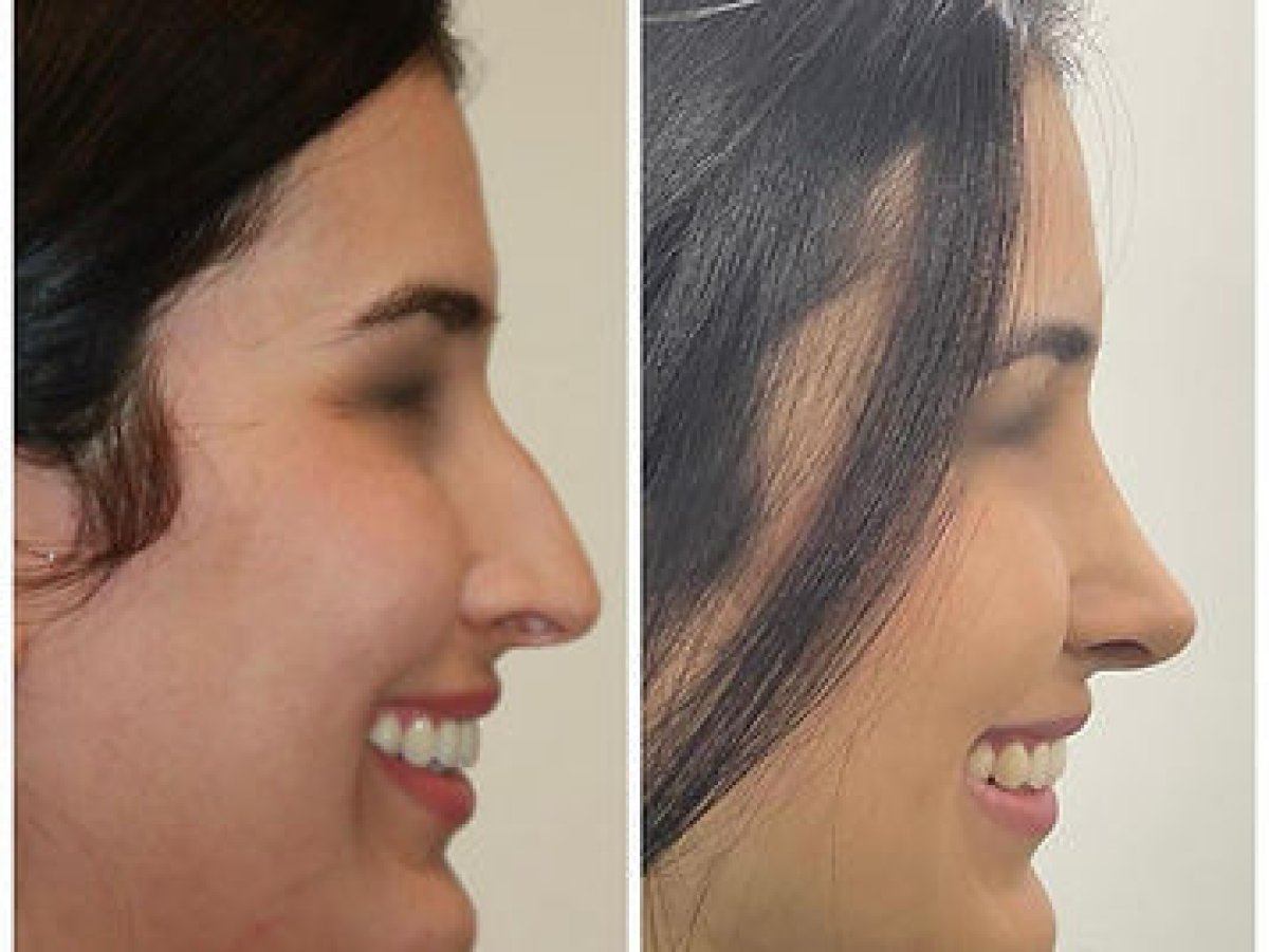 before and after photo
